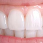Bleaching